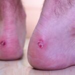 The Definitive Guide to Managing Athlete’s Foot: Symptoms, Clinical Treatments, and Long-Term Prevention Strategies