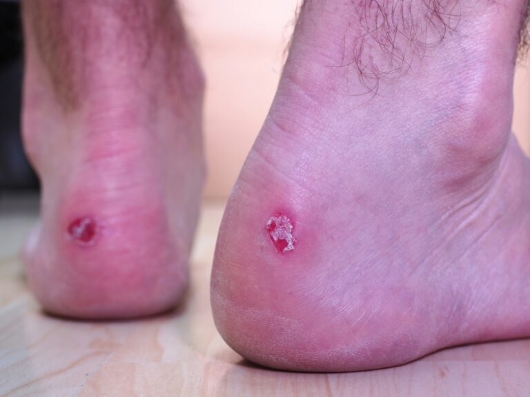 The Definitive Guide to Managing Athlete’s Foot: Symptoms, Clinical Treatments, and Long-Term Prevention Strategies